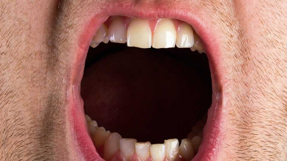 What Is Meth Mouth Is is a combination of blackened or stained teeth combined with dry mouth.